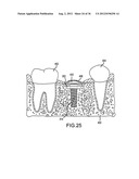 ANGLED DENTAL PLATFORM ASSEMBLY AND METHODS diagram and image