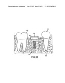 ANGLED DENTAL PLATFORM ASSEMBLY AND METHODS diagram and image