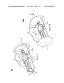 Systems and Methods Which Remove Material From Blood Vessel Walls diagram and image