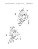 Systems and Methods Which Remove Material From Blood Vessel Walls diagram and image