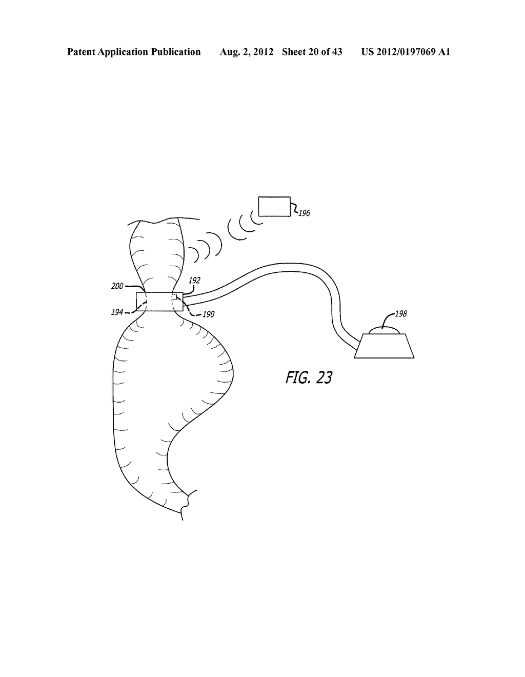 ASSEMBLY AND METHOD FOR AUTOMATICALLY CONTROLLING PRESSURE FOR A GASTRIC     BAND - diagram, schematic, and image 21