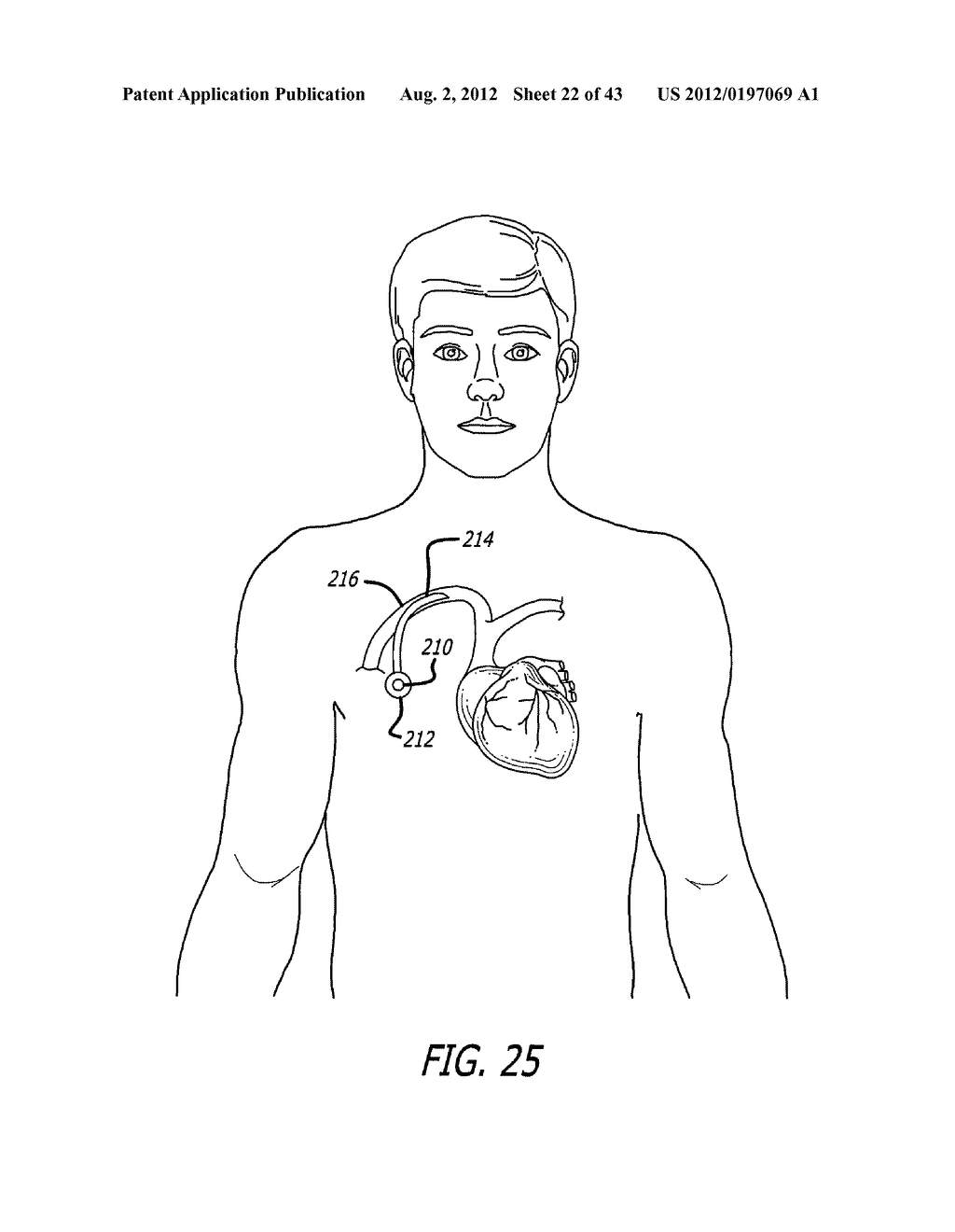 ASSEMBLY AND METHOD FOR AUTOMATICALLY CONTROLLING PRESSURE FOR A GASTRIC     BAND - diagram, schematic, and image 23