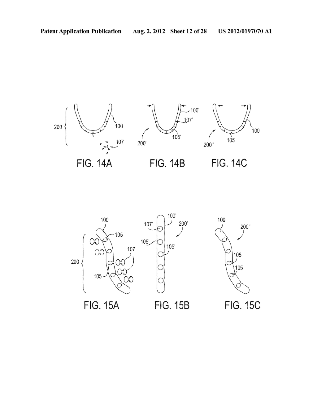 PARTIALLY ERODABLE SYSTEMS FOR TREATMENT OF OBSTRUCTIVE SLEEP APNEA - diagram, schematic, and image 13