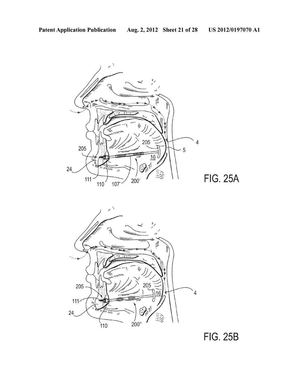 PARTIALLY ERODABLE SYSTEMS FOR TREATMENT OF OBSTRUCTIVE SLEEP APNEA - diagram, schematic, and image 22