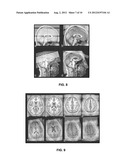 SYSTEM AND METHODS FOR AUTOMATIC PLACEMENT OF SPATIAL SUPRESSION REGIONS     IN MRI AND MRSI diagram and image