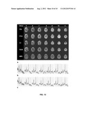 SYSTEM AND METHODS FOR AUTOMATIC PLACEMENT OF SPATIAL SUPRESSION REGIONS     IN MRI AND MRSI diagram and image