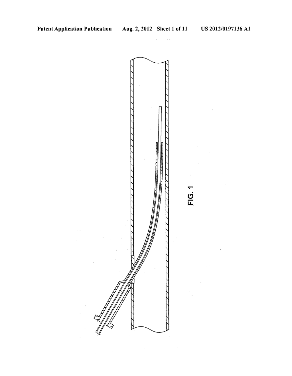 SELF-PUNCTURING PERCUTANEOUS OPTICAL SENSOR FOR OPTICAL SENSING OF     INTRAVASCULAR FLUID - diagram, schematic, and image 02