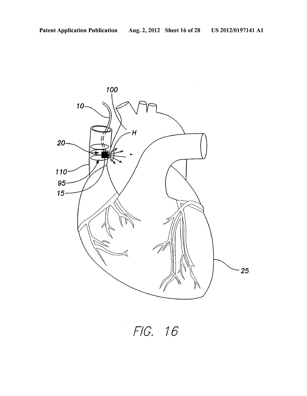 IMPLANTABLE ECHO DOPPLER FLOW SENSOR FOR MONITORING OF HEMODYNAMICS - diagram, schematic, and image 17