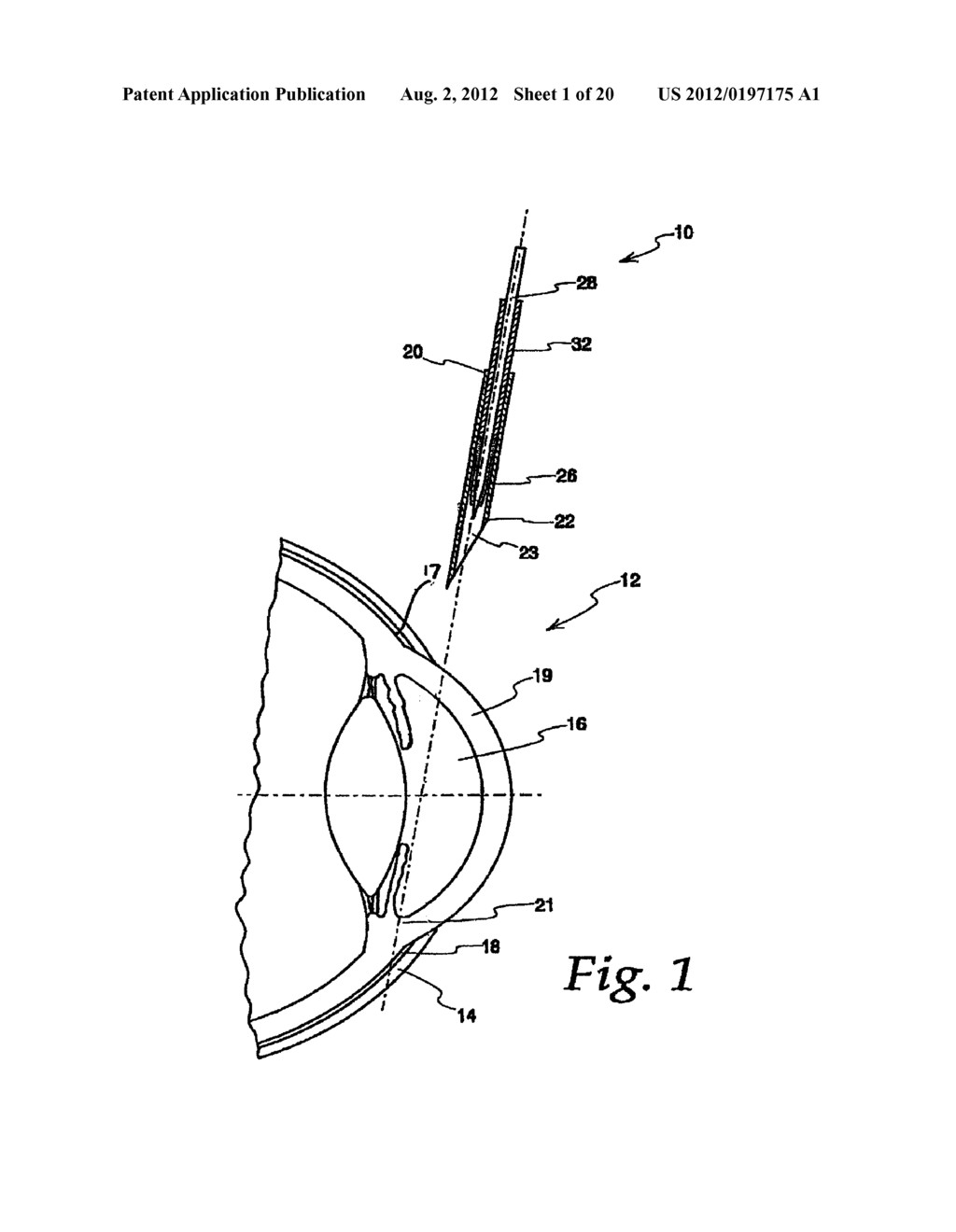 METHODS, SYSTEMS AND APPARATUS FOR RELIEVING PRESSURE IN AN ORGAN - diagram, schematic, and image 02