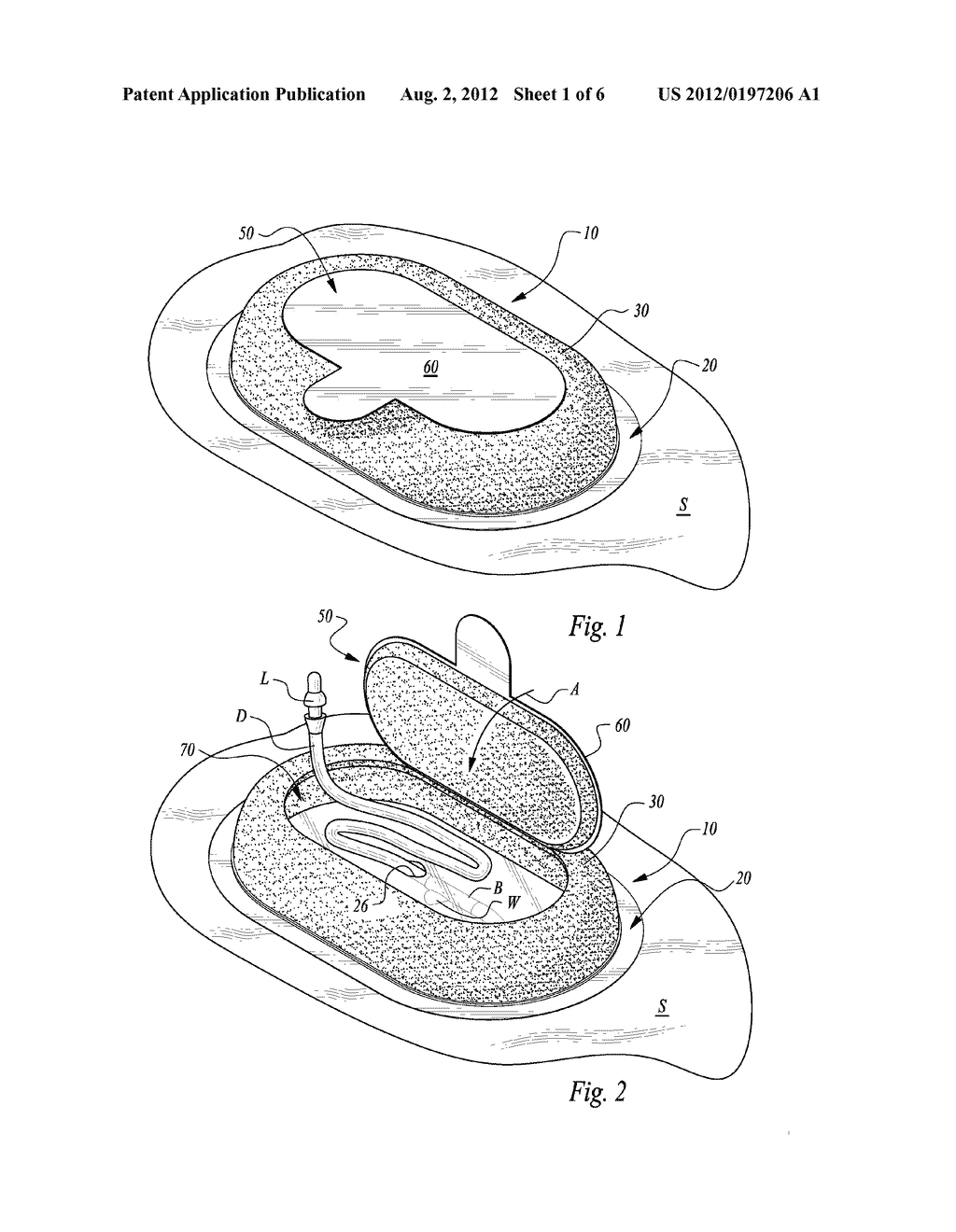 ADHESIVE DRESSING WITH RESEALABLE COVER - diagram, schematic, and image 02