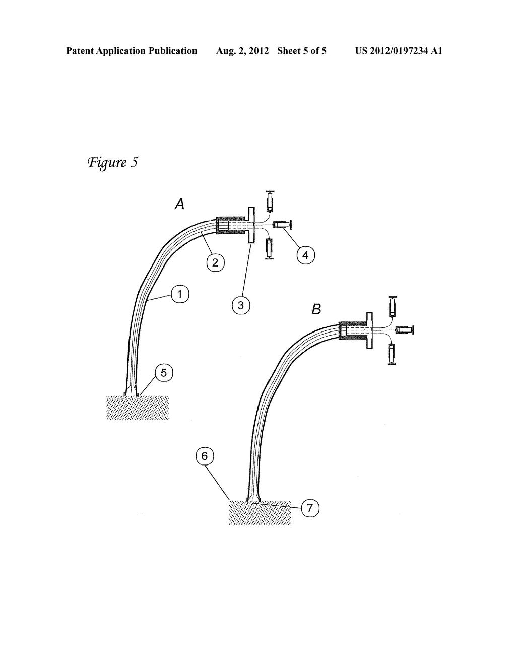 DELIVERY METHODS FOR A BIOLOGICAL PACEMAKER MINIMIZING SOURCE-SINK     MISMATCH - diagram, schematic, and image 06