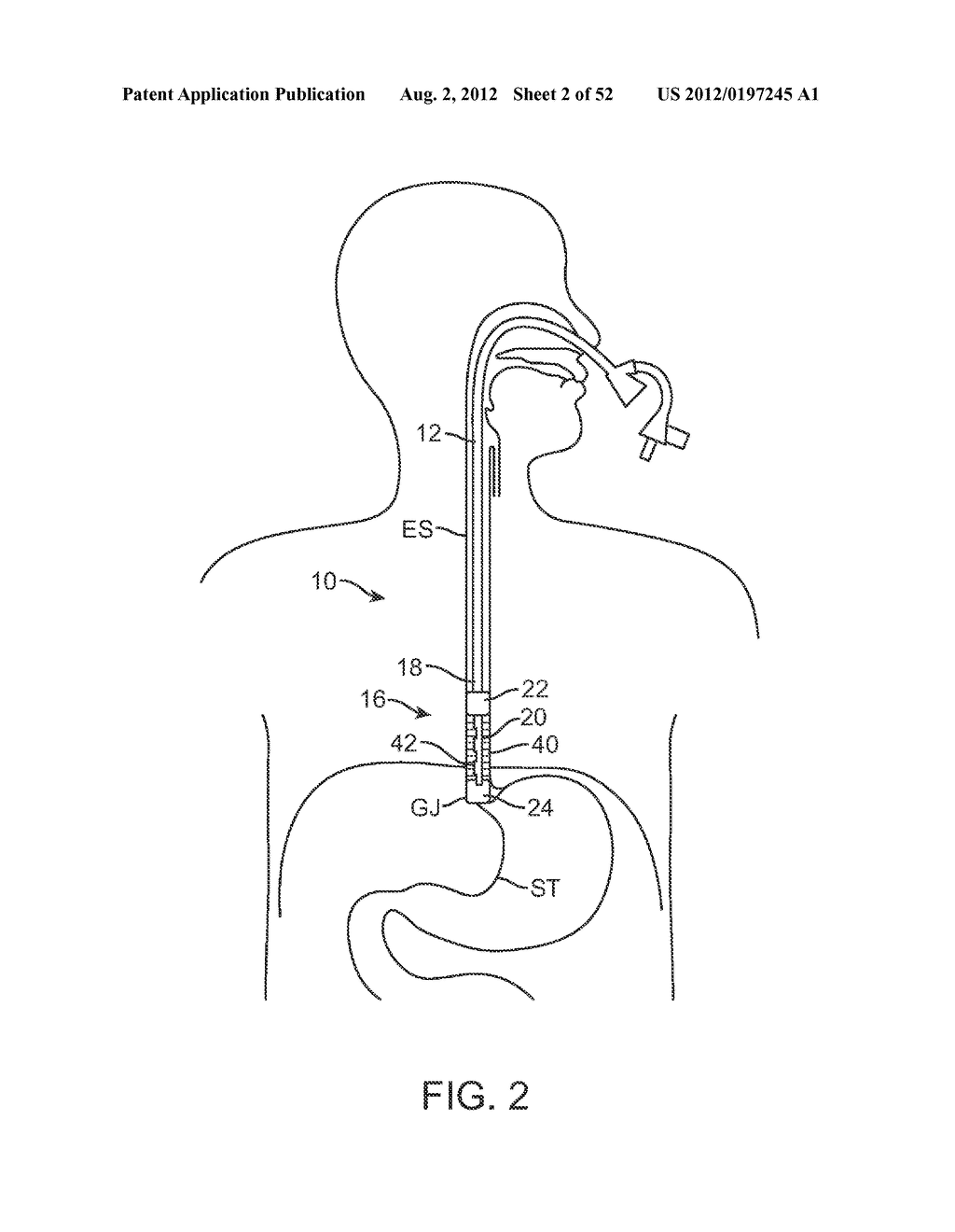 METHODS AND APPARATUS FOR CYROGENIC TREATMENT OF A BODY CAVITY OR LUMEN - diagram, schematic, and image 03