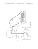 METHODS AND APPARATUS FOR CYROGENIC TREATMENT OF A BODY CAVITY OR LUMEN diagram and image