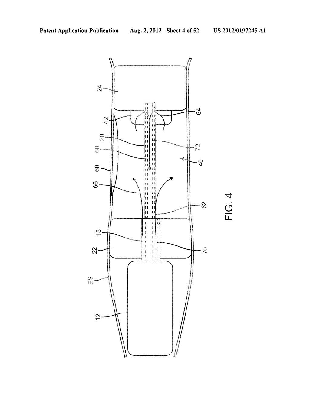 METHODS AND APPARATUS FOR CYROGENIC TREATMENT OF A BODY CAVITY OR LUMEN - diagram, schematic, and image 05