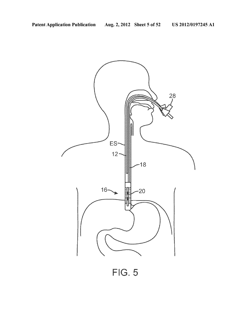 METHODS AND APPARATUS FOR CYROGENIC TREATMENT OF A BODY CAVITY OR LUMEN - diagram, schematic, and image 06