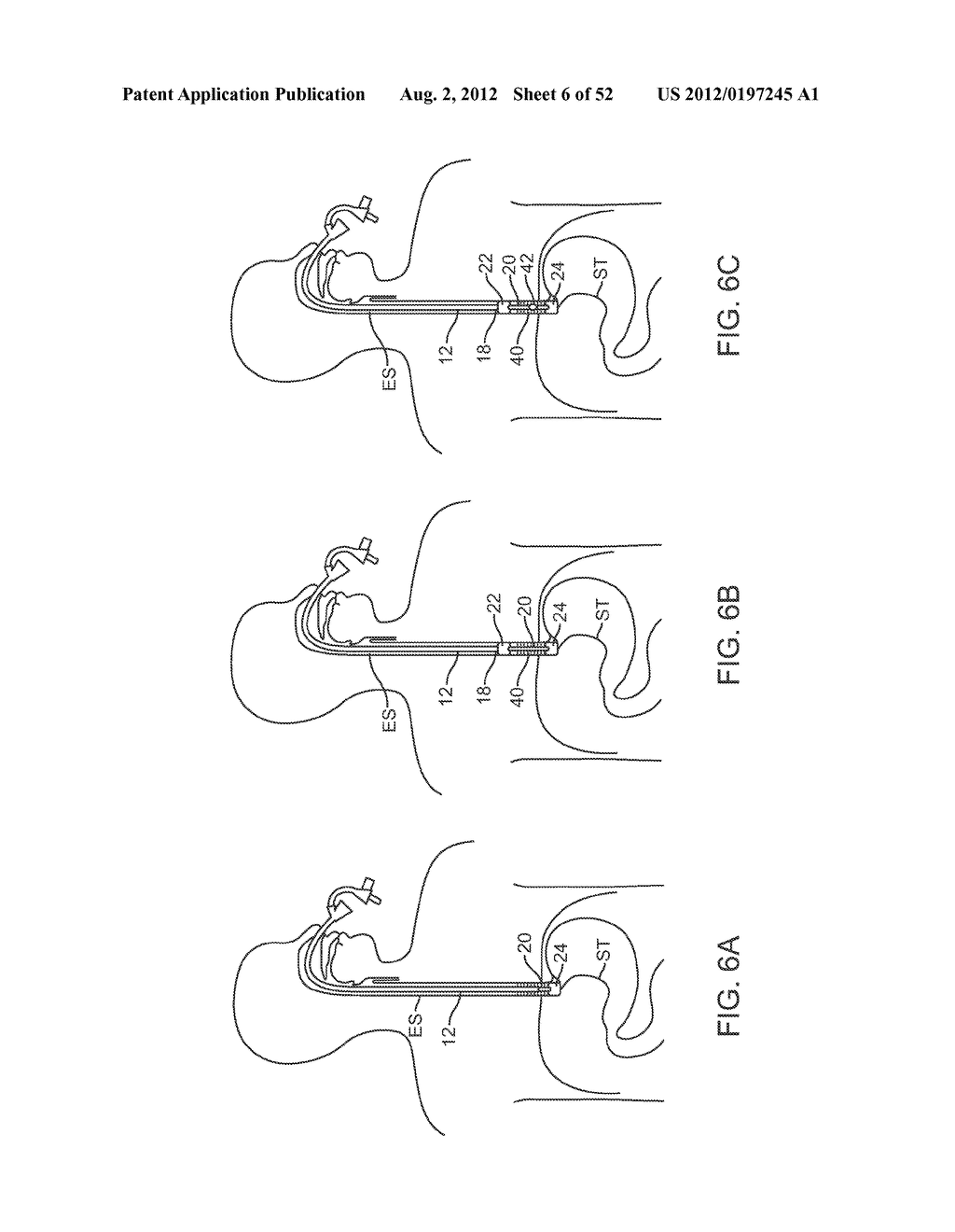 METHODS AND APPARATUS FOR CYROGENIC TREATMENT OF A BODY CAVITY OR LUMEN - diagram, schematic, and image 07