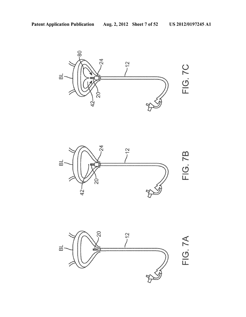 METHODS AND APPARATUS FOR CYROGENIC TREATMENT OF A BODY CAVITY OR LUMEN - diagram, schematic, and image 08