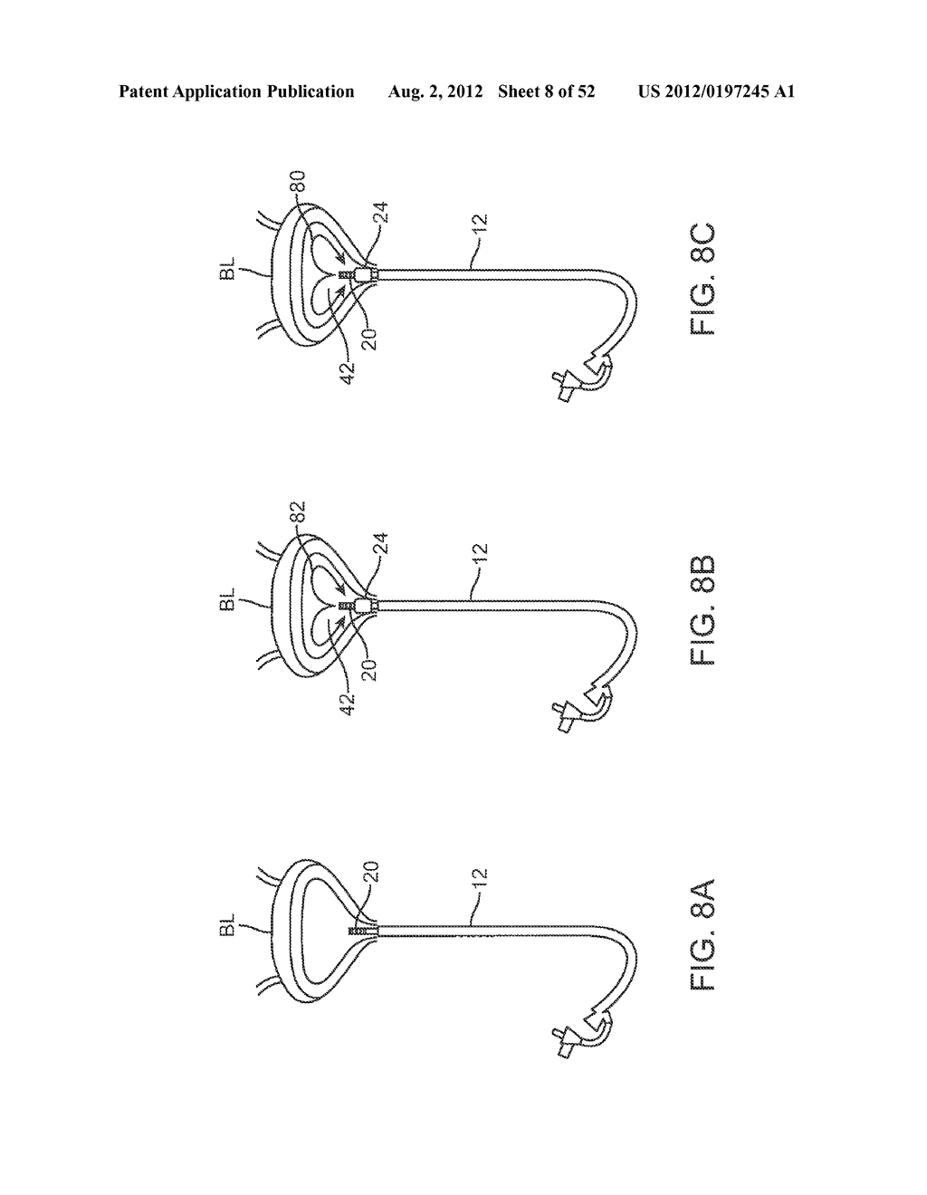 METHODS AND APPARATUS FOR CYROGENIC TREATMENT OF A BODY CAVITY OR LUMEN - diagram, schematic, and image 09