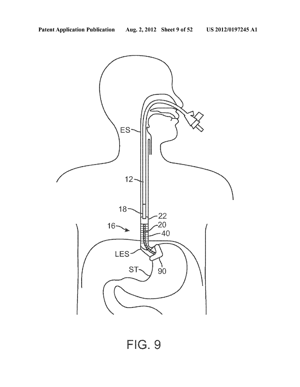 METHODS AND APPARATUS FOR CYROGENIC TREATMENT OF A BODY CAVITY OR LUMEN - diagram, schematic, and image 10