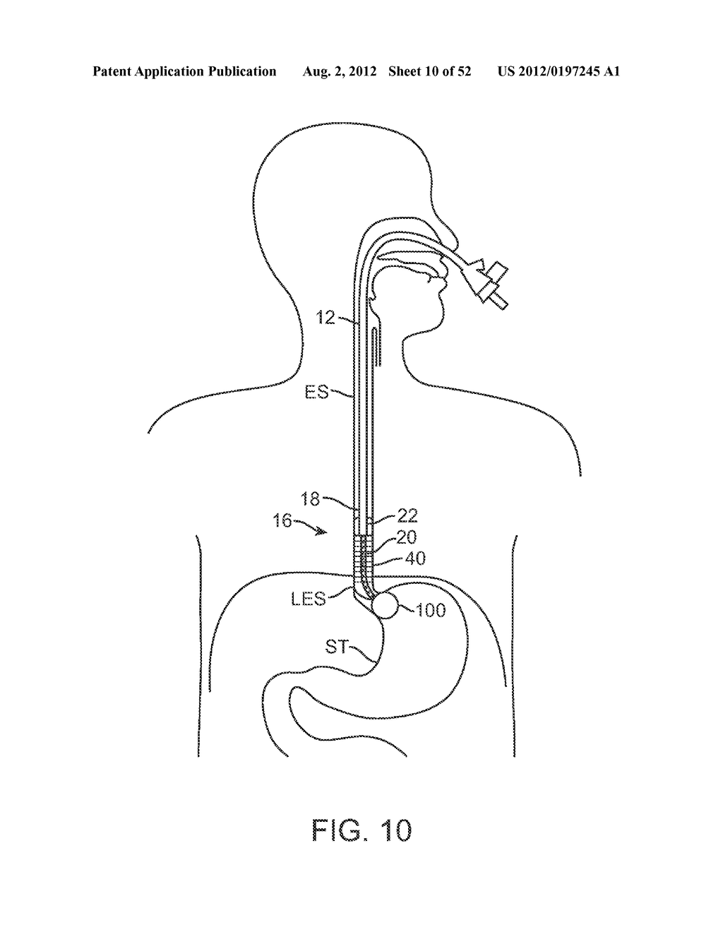 METHODS AND APPARATUS FOR CYROGENIC TREATMENT OF A BODY CAVITY OR LUMEN - diagram, schematic, and image 11