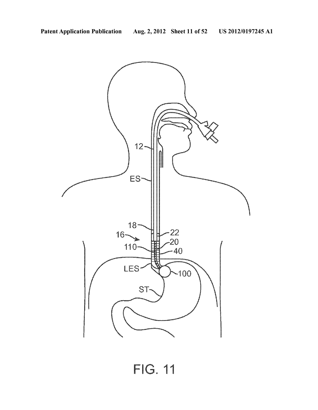 METHODS AND APPARATUS FOR CYROGENIC TREATMENT OF A BODY CAVITY OR LUMEN - diagram, schematic, and image 12