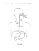 METHODS AND APPARATUS FOR CYROGENIC TREATMENT OF A BODY CAVITY OR LUMEN diagram and image