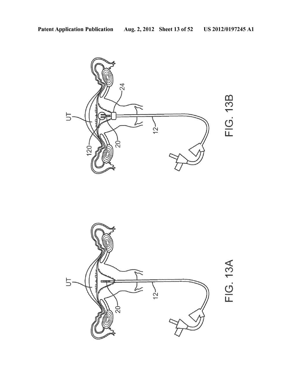 METHODS AND APPARATUS FOR CYROGENIC TREATMENT OF A BODY CAVITY OR LUMEN - diagram, schematic, and image 14