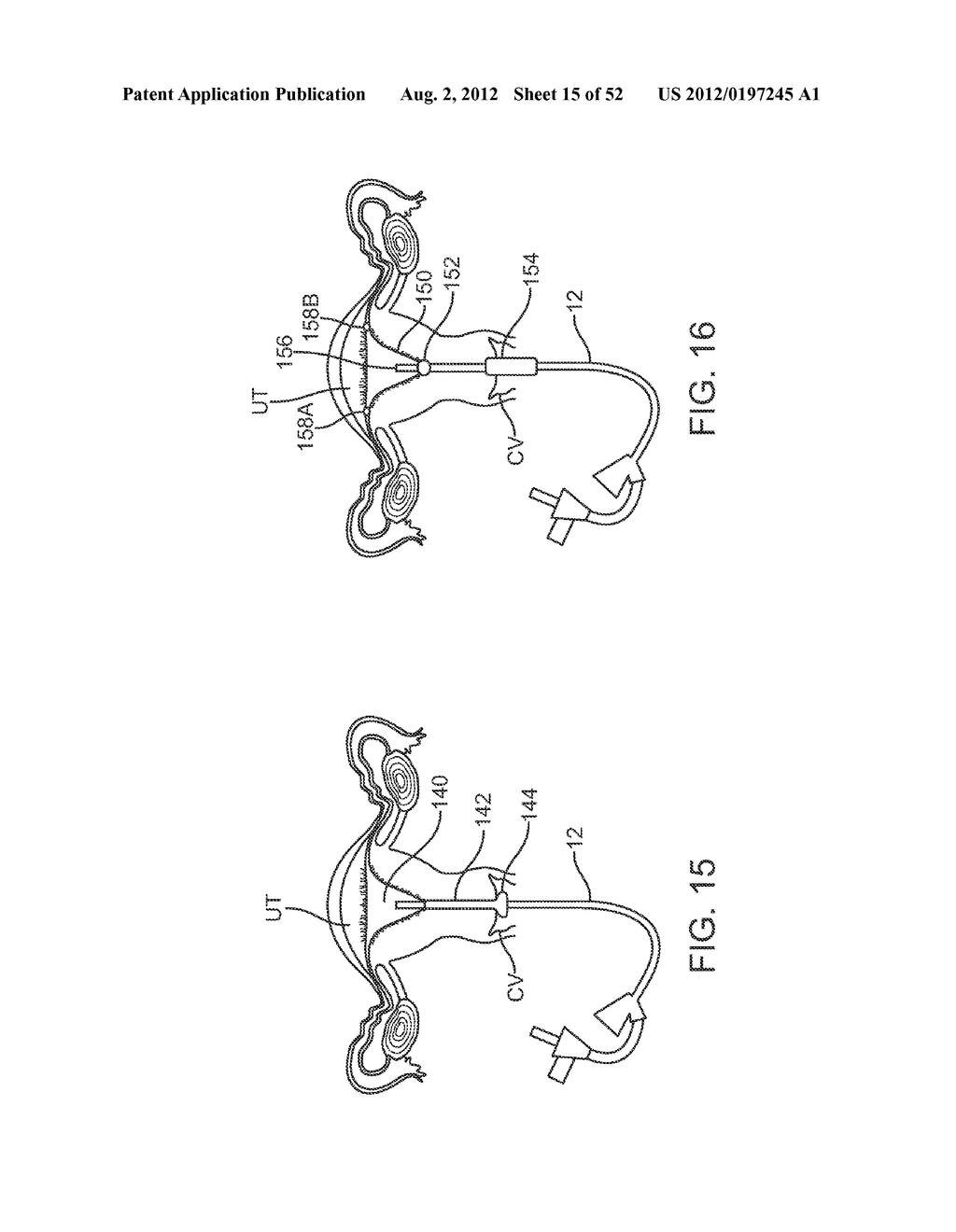 METHODS AND APPARATUS FOR CYROGENIC TREATMENT OF A BODY CAVITY OR LUMEN - diagram, schematic, and image 16