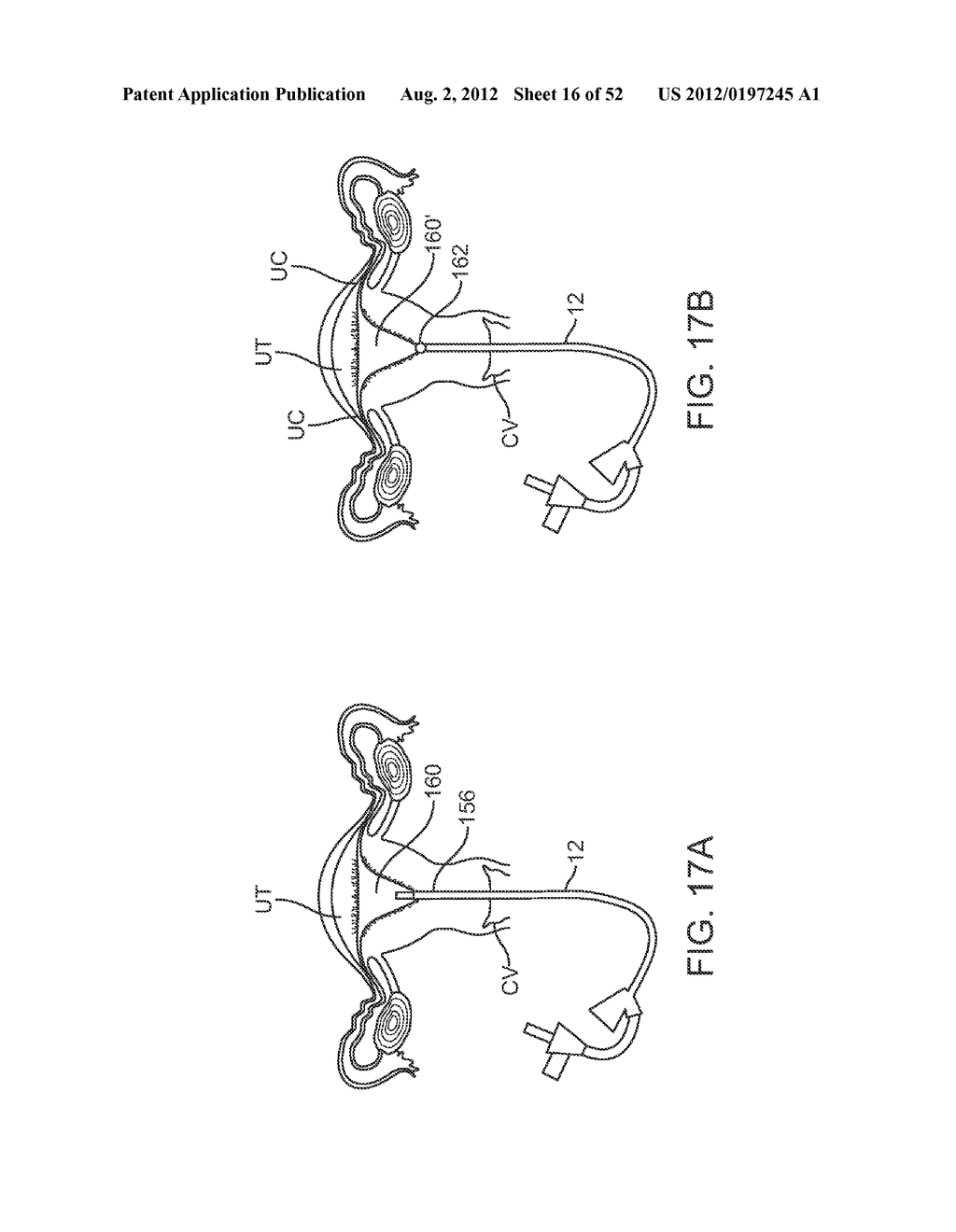 METHODS AND APPARATUS FOR CYROGENIC TREATMENT OF A BODY CAVITY OR LUMEN - diagram, schematic, and image 17