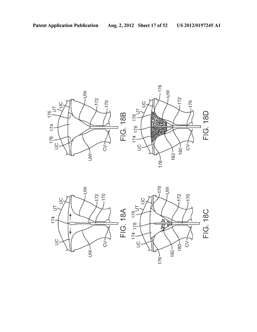 METHODS AND APPARATUS FOR CYROGENIC TREATMENT OF A BODY CAVITY OR LUMEN - diagram, schematic, and image 18