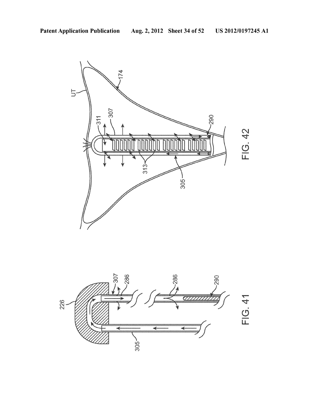 METHODS AND APPARATUS FOR CYROGENIC TREATMENT OF A BODY CAVITY OR LUMEN - diagram, schematic, and image 35
