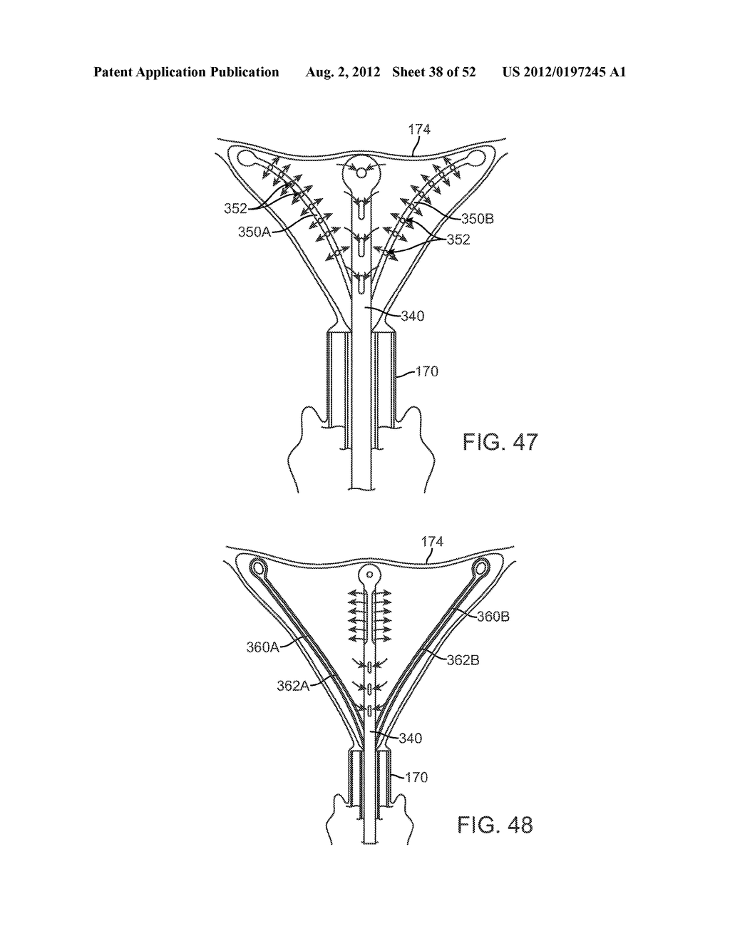 METHODS AND APPARATUS FOR CYROGENIC TREATMENT OF A BODY CAVITY OR LUMEN - diagram, schematic, and image 39