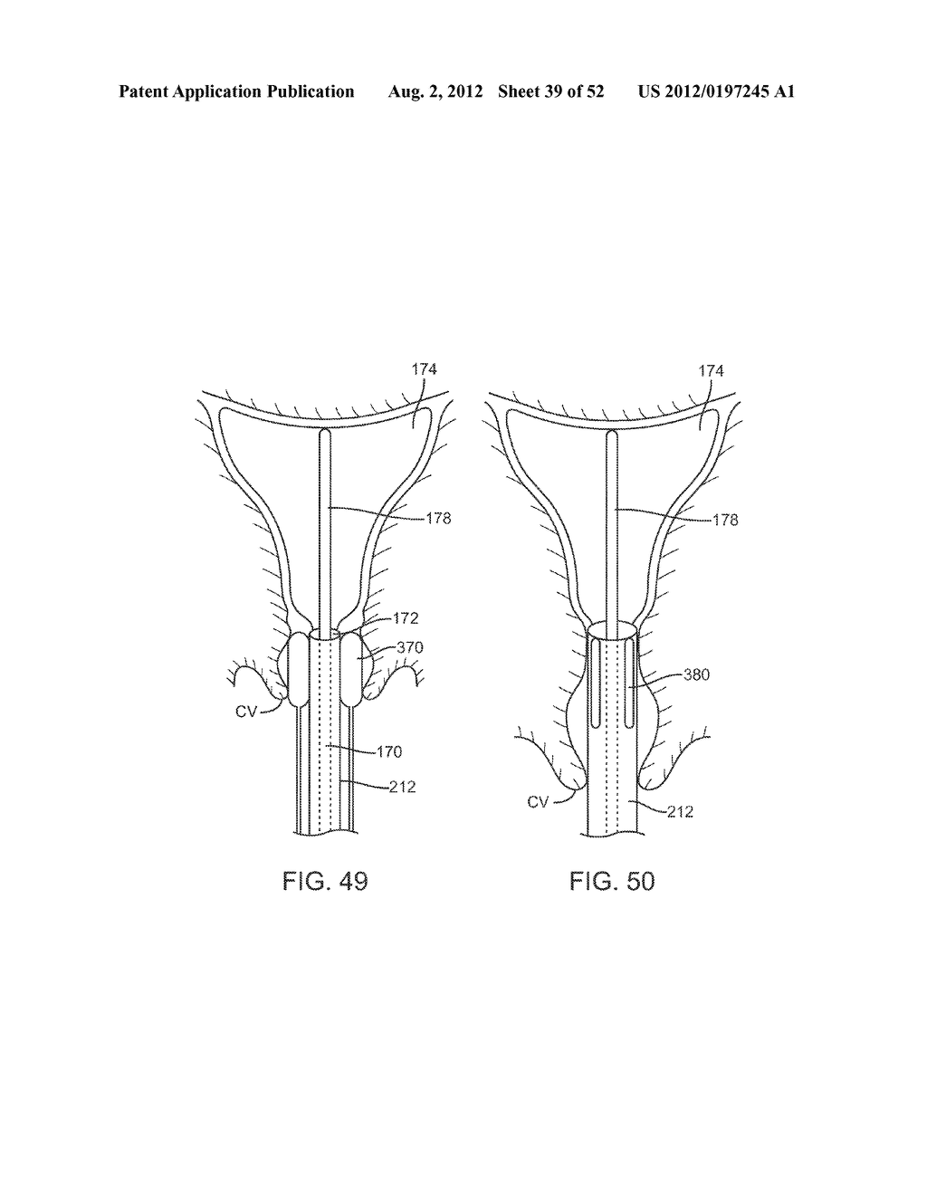 METHODS AND APPARATUS FOR CYROGENIC TREATMENT OF A BODY CAVITY OR LUMEN - diagram, schematic, and image 40