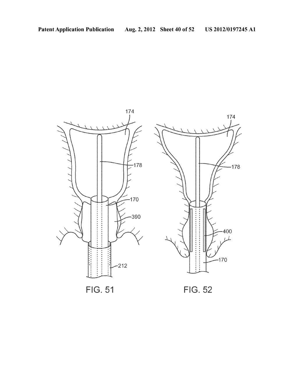 METHODS AND APPARATUS FOR CYROGENIC TREATMENT OF A BODY CAVITY OR LUMEN - diagram, schematic, and image 41