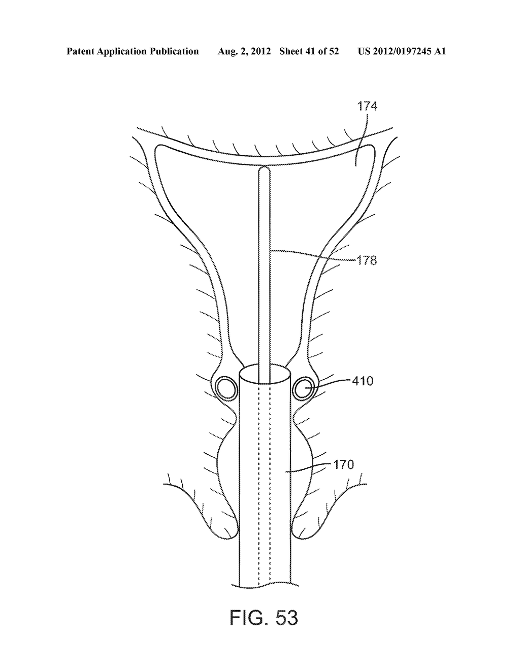 METHODS AND APPARATUS FOR CYROGENIC TREATMENT OF A BODY CAVITY OR LUMEN - diagram, schematic, and image 42