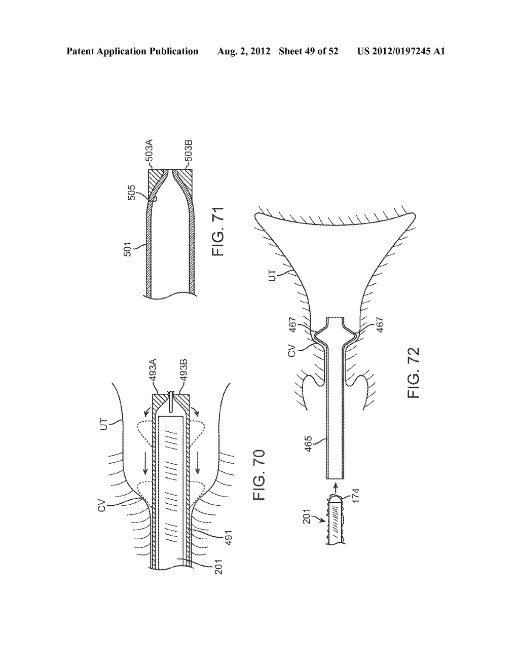 METHODS AND APPARATUS FOR CYROGENIC TREATMENT OF A BODY CAVITY OR LUMEN - diagram, schematic, and image 50
