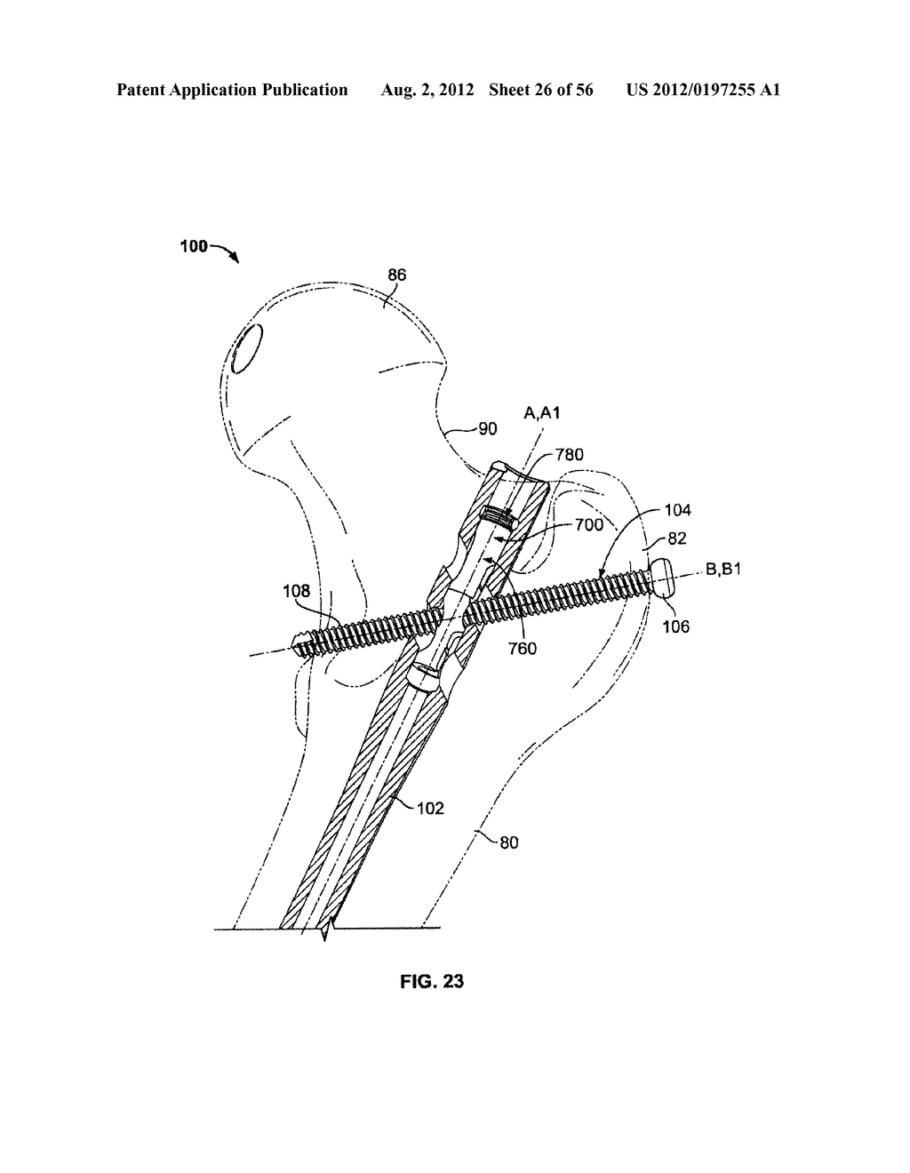 Lockable Intramedullary Fixation Device - diagram, schematic, and image 27