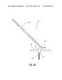 Rod Coercer diagram and image