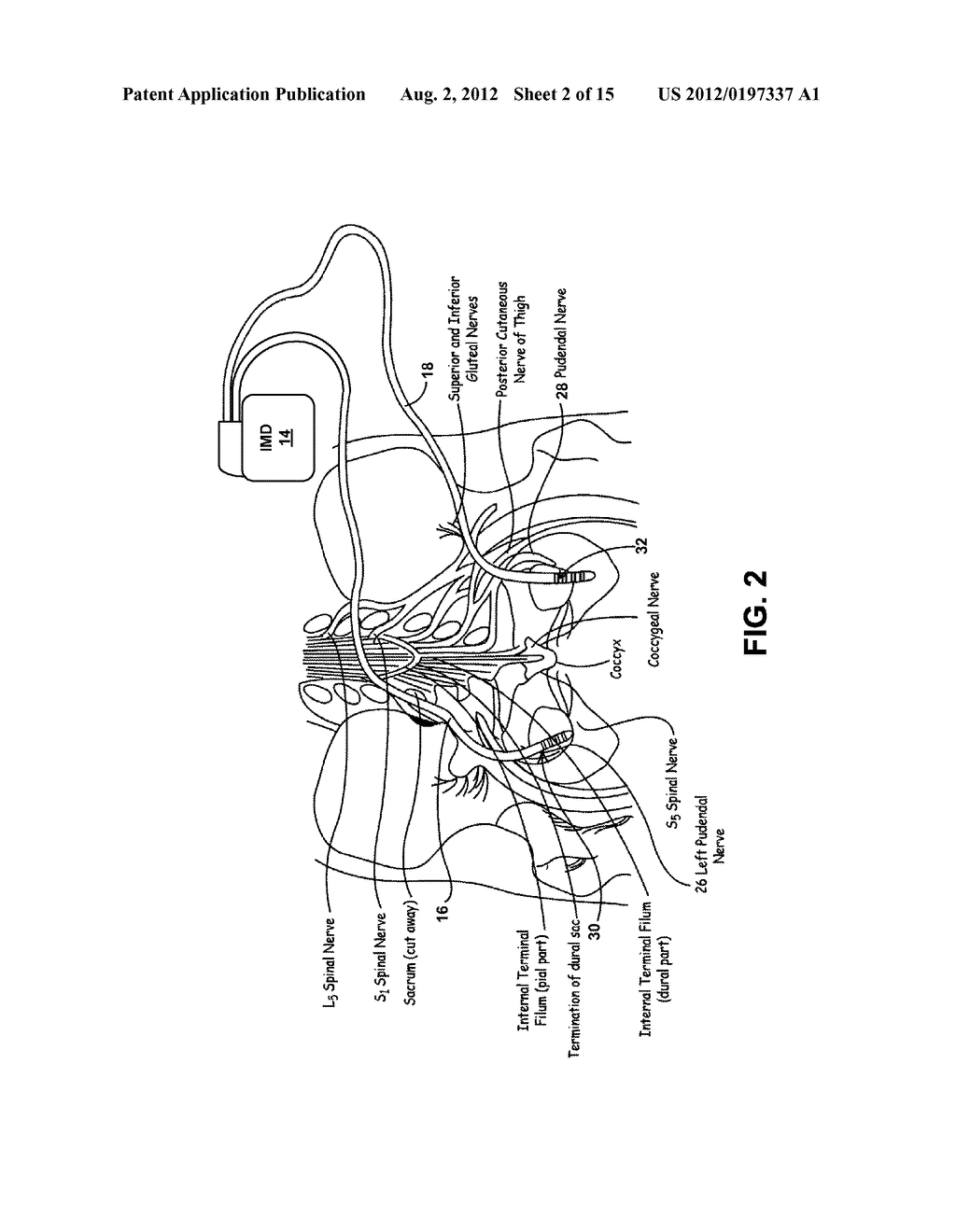 BILATERAL ELECTRICAL STIMULATION THERAPY FOR BLADDER DYSFUNCTION - diagram, schematic, and image 03