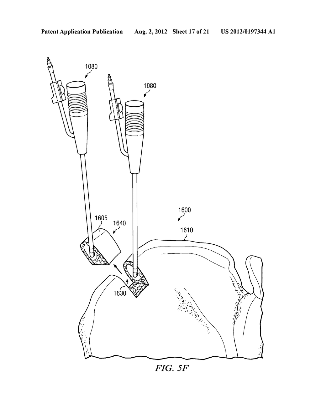 ELECTROSURGICAL SYSTEM AND METHOD FOR TREATING HARD BODY TISSUE - diagram, schematic, and image 18