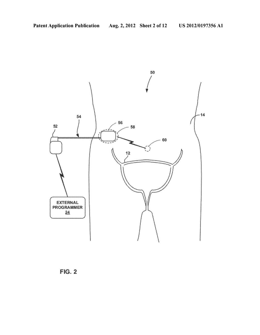 Waveforms for Remote Electrical Stimulation Therapy - diagram, schematic, and image 03