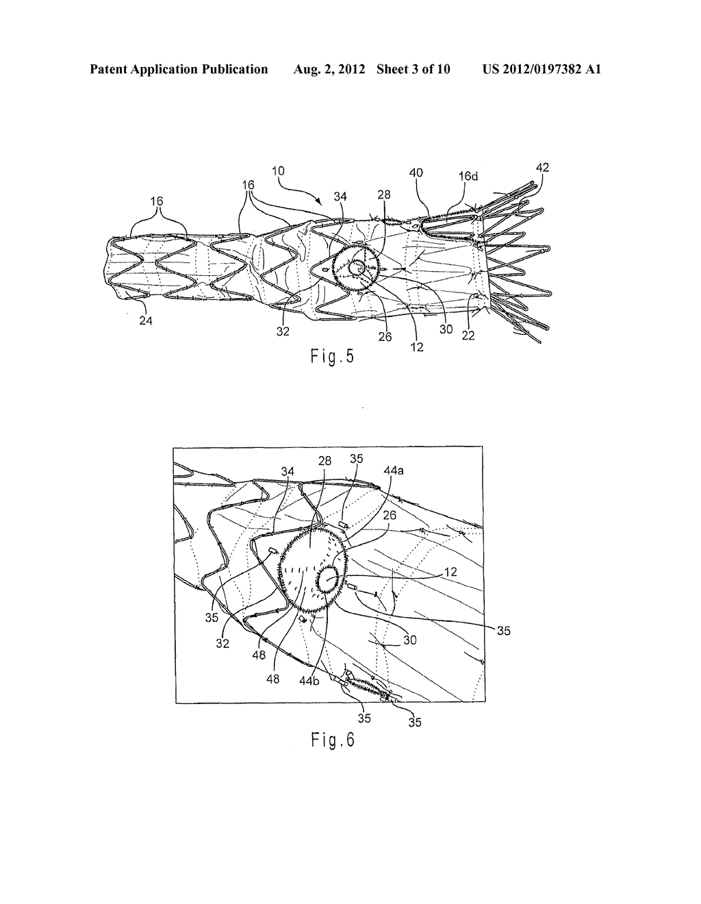 ENDOLUMINAL PROSTHESIS COMPRISING A VALVE REPLACEMENT AND AT LEAST ONE     FENESTRATION - diagram, schematic, and image 04