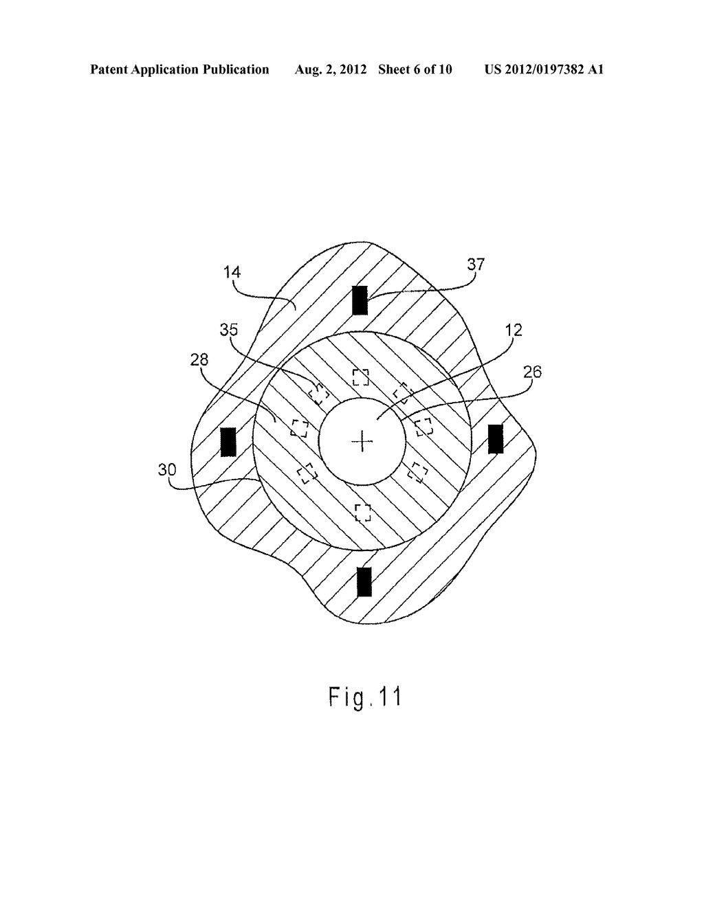 ENDOLUMINAL PROSTHESIS COMPRISING A VALVE REPLACEMENT AND AT LEAST ONE     FENESTRATION - diagram, schematic, and image 07