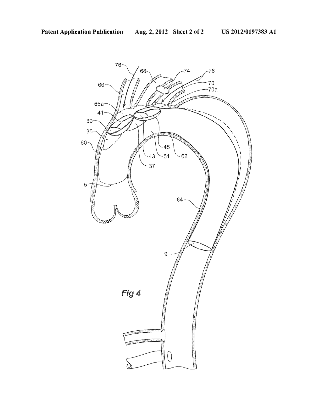 THORACIC STENT GRAFT WITH GUIDE ARRANGEMENT - diagram, schematic, and image 03