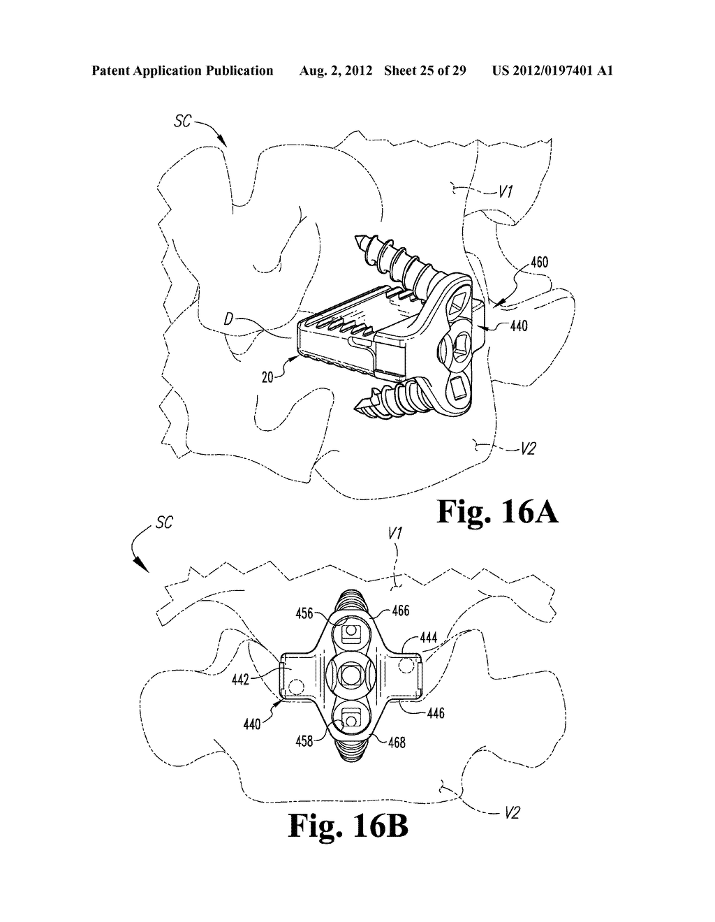 INTERBODY SPINAL IMPLANTS WITH MODULAR ADD-ON DEVICES - diagram, schematic, and image 26