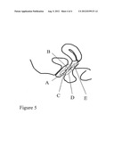 IMPLANT FOR TREATMENT OF VAGINAL AND/OR UTERINE PROLAPSE diagram and image