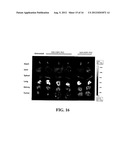 LIPOSOMES COMPRISING A CALCIUM PHOSPHATE-CONTAINING PRECIPITATE diagram and image