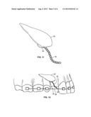 Direct Placement System for Tooth Extrusion diagram and image