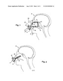 SURGICAL SHIELD FOR SOFT TISSUE PROTECTION diagram and image