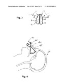 SURGICAL SHIELD FOR SOFT TISSUE PROTECTION diagram and image